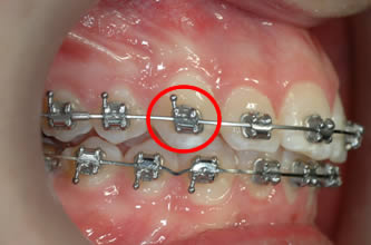 Cas d'urgence au Cabinet d'orthodontie exclusive du Dr. FAVALI à Dax