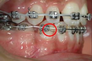 Cas d'urgence au Cabinet d'orthodontie exclusive du Dr. FAVALI à Dax